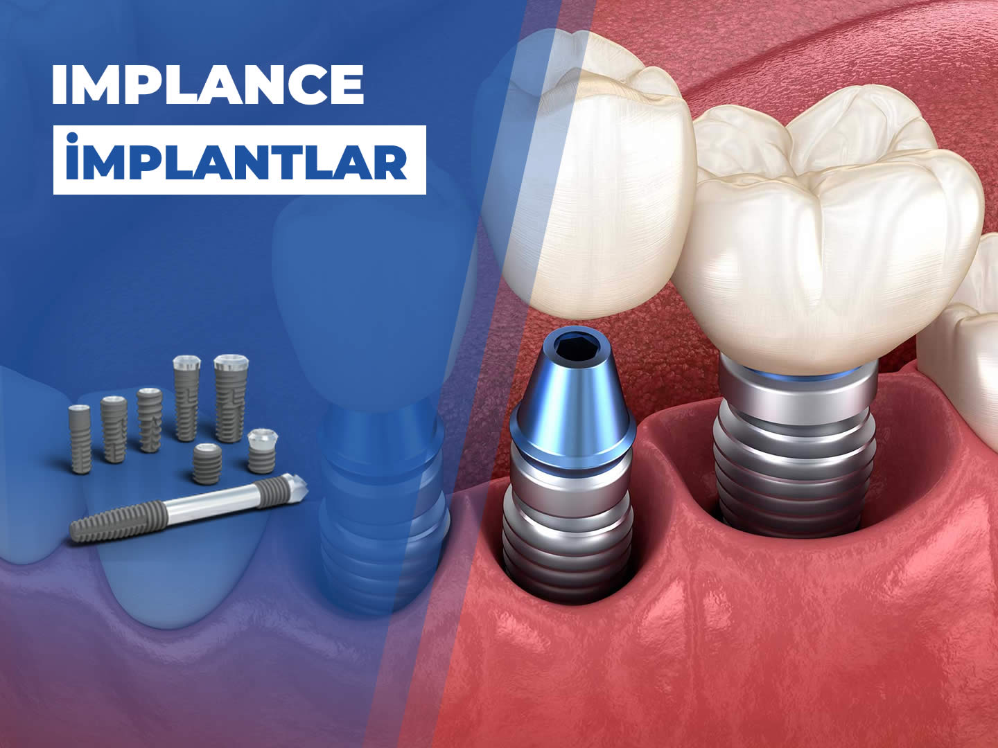 Implance İmplant Neden Tercih Edilmeli?