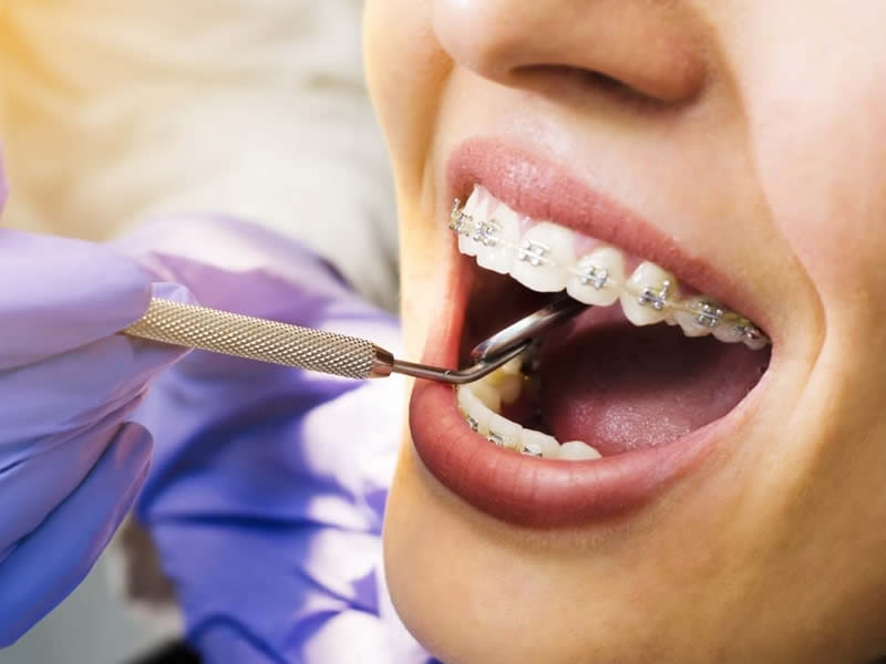 Ortodonti Tedavisi