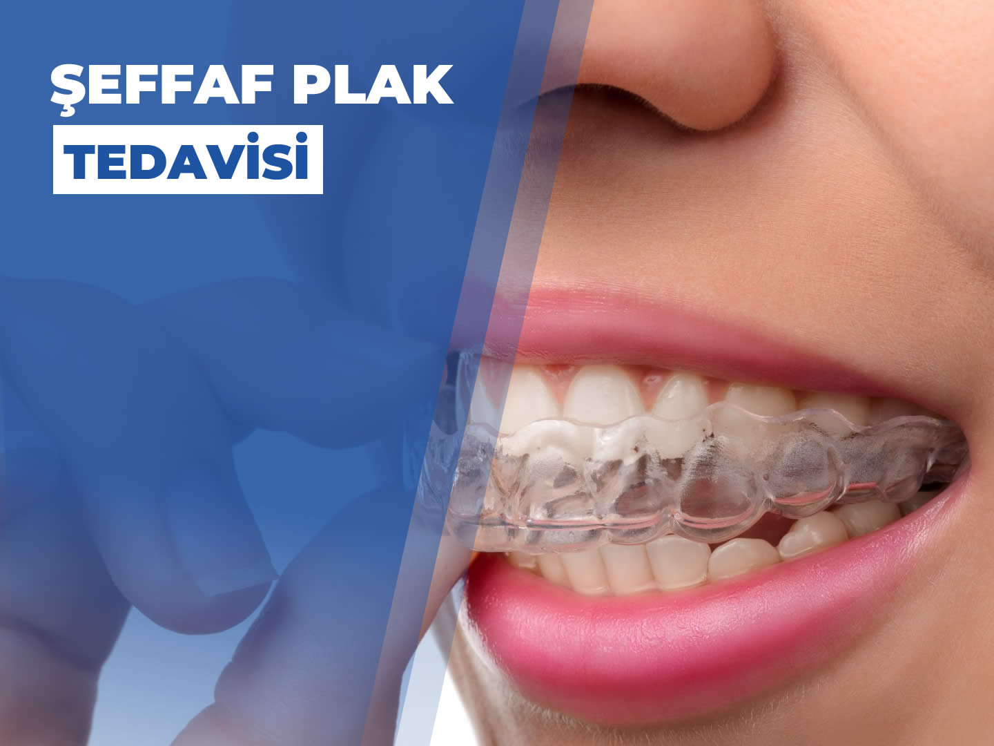 Şeffaf Plak Tedavisi Nedir? Avantajları ve Uygulama Süreci