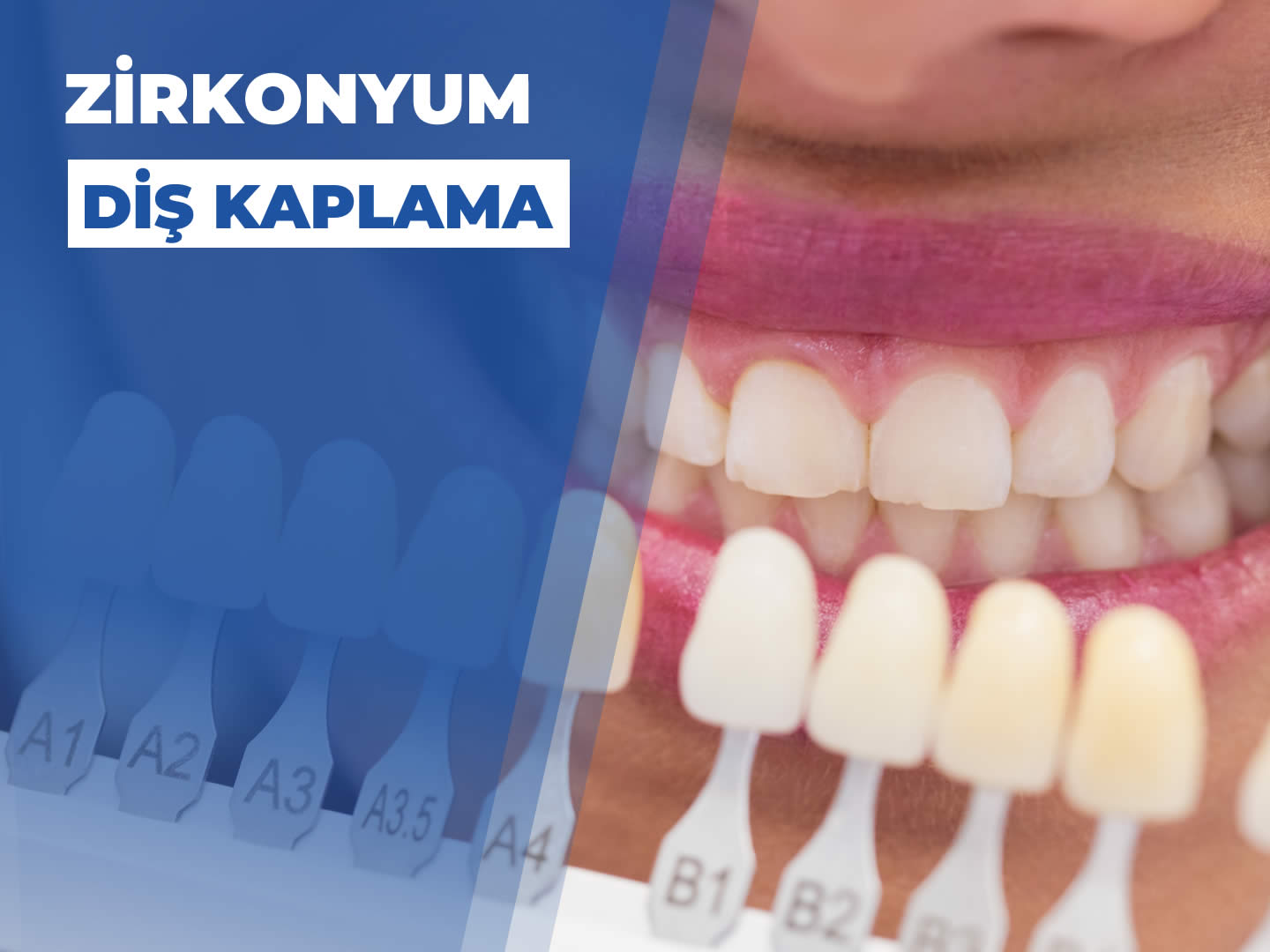 Zirkonyum Diş Kaplama